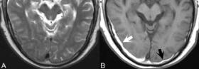 硬膜外、硬膜下出血与蛛网膜下腔出血的磁共振影像学特征